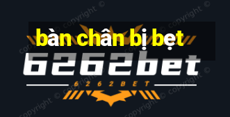 bàn chân bị bẹt